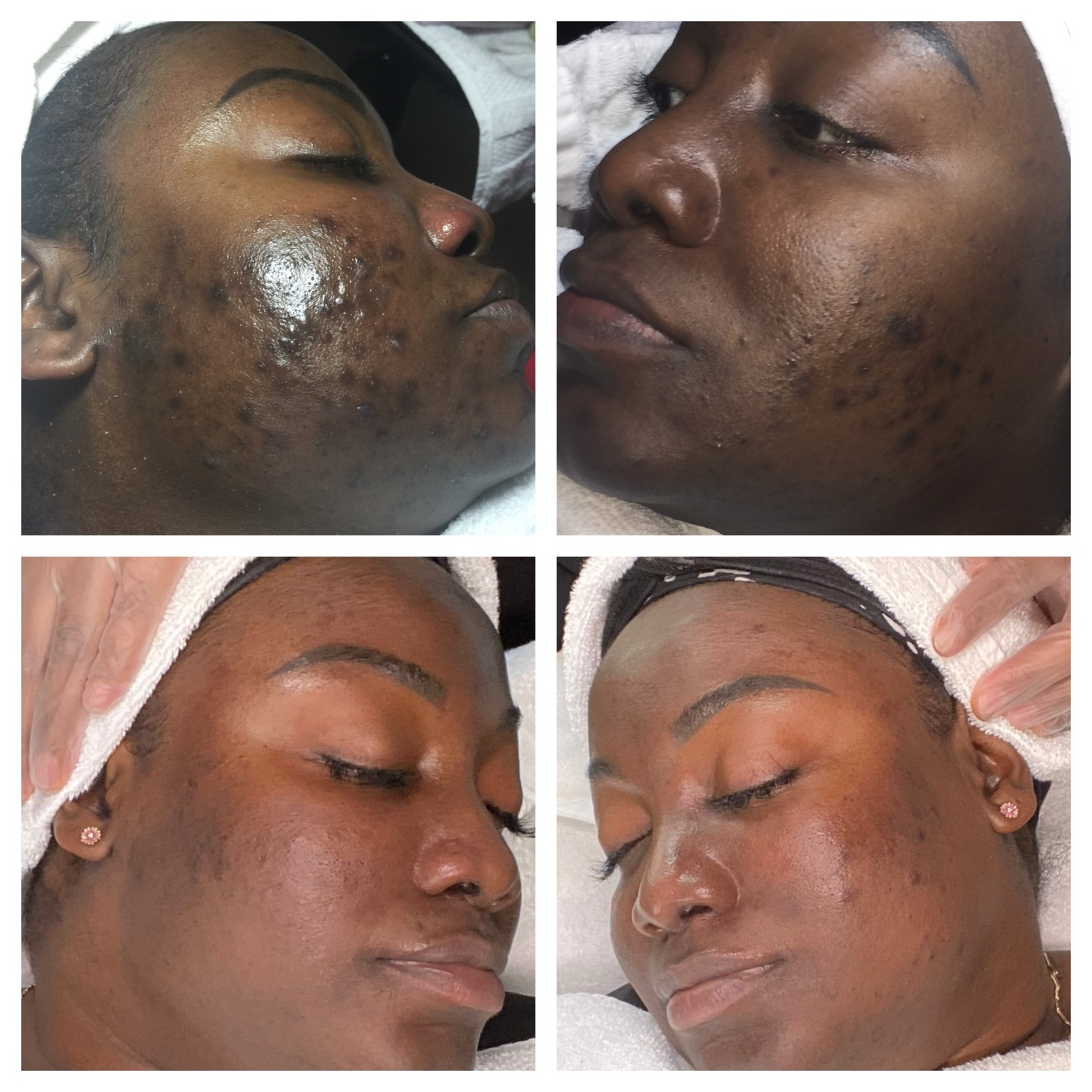 These amazing results were accomplished using our A’Unique Skin Resurfacing Night Treatment. This exquisite formula works tirelessly while you rest, encouraging cell turnover and unveiling a smoother, more luminous complexion with each awakening.
A’Unique Skin Resurfacing Night Treatment is designed by our licensed esthetician to elevate your nightly beauty ritual. This luxurious formula blends science and nature to transform your skin while you sleep.
Elevate your skincare routine with A’Unique Night Treatment. Where science meets indulgence. Treat yourself to timeless elegance and wake up to a renewed, radiant complexion. Available on Auniqueskinstore.com