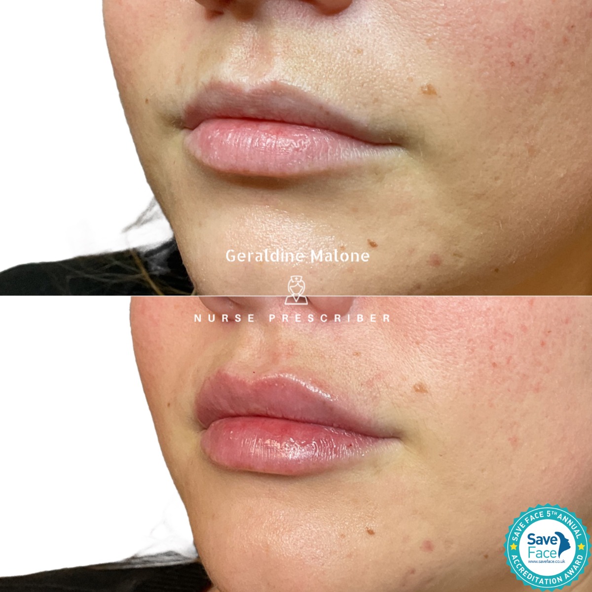 0.5ml Lip Enhancement Treatment with Top Quality Dermal Filler
✨Hydration and subtle volume, whilst maintaining natural shape and proportion
- NO edited images
- Treatment price: 0.5ml/£145, 1ml/£225
- Recovery time: 24/48hrs
- Results lasting 6-12 months
All treatments carried out by Nurse Prescriber Geraldine Malone in a Save Face Registered Clinic
Book Now via the link below:
https://www.geraldinemalone.co.uk/book-appointment
Contact Us:
☎️ 024 7792 1812
📧 geraldinemaloneaesthetics@outlook.com