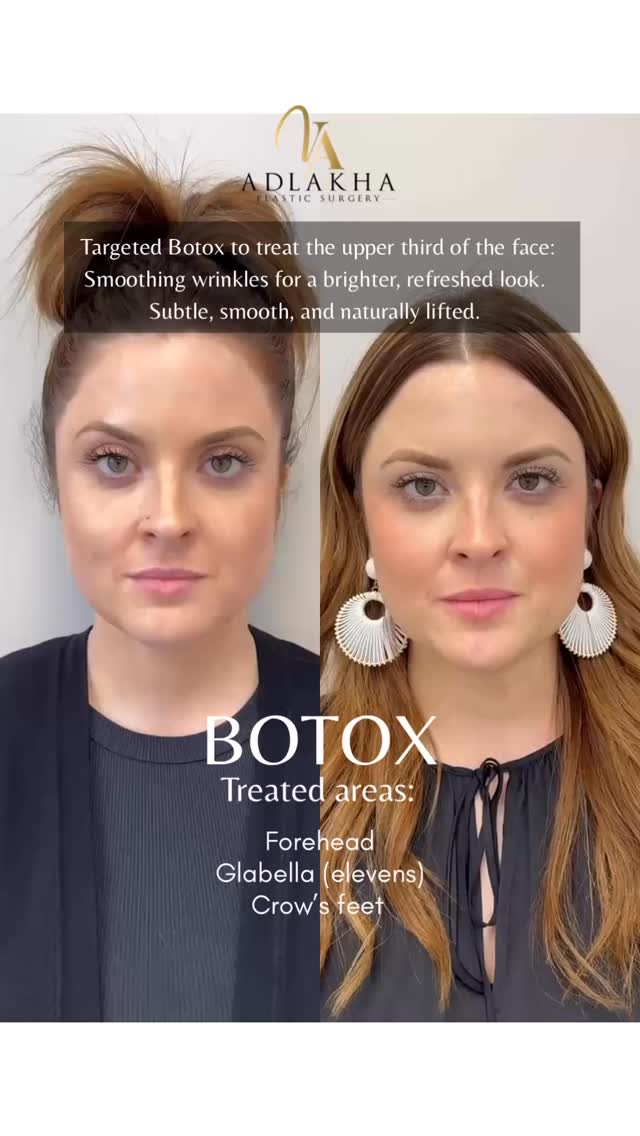 ✨ Botox for the upper third of the face targets common areas like the forehead, frown lines (11s), and crow’s feet — helping to relax overactive muscles and soften the appearance of wrinkles. The result? A smoother, more open and refreshed look without sacrificing natural expression.
This subtle tweak can brighten your eyes, lift your brow, and give your entire face a more youthful and rested appearance. When done well, you won’t look “frozen”—just like the most well-rested version of you. 💉✨
📍 Treatment time: 10–15 minutes
⏳ No downtime
🌿 Results appear in ~7 days and last 3–4 months
To book your complimentary consultation you can:
📞Call 234 458 2010
📲DM @dr.vidhiadlakha
📧Email us info@adlakhaplasticsurgery.com
💻Visit the website in my bio
.
.
.
This is an actual patient of Dr. Vidhi Adlakha. All photos are released with consent. Please do not use or distribute without permission.
#ohiosurgeon #plasticsurgeon #tox #botox #dysport #naturalresults #botoxbrowlift #browlift #hoodedeyes #lipflip #botoxlipflip #beforeandafter #adlakhaaesthetics
#PlasticSurgery #BeforeAndAfter #SurgicalResults #femaleplasticsurgeon #babybotox
#skincare #wrinkles #antiwrinkle #antiaging #skincare #skincareroutine #aesthetics #aesthetician