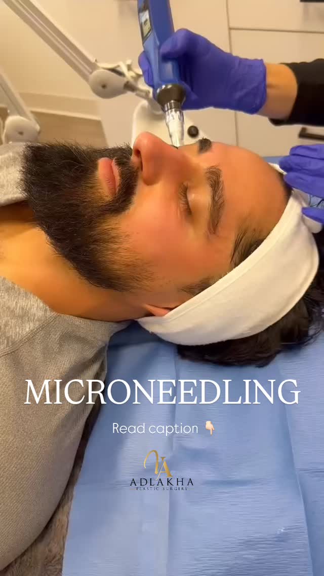 Men’s aesthetic treatments are on the rise 📈
Men now account for ~15–20% of aesthetic treatments, with skin treatments leading the way.
What is microneedling? 💉
A minimally invasive skin treatment that improves skin quality without changing facial features.
How it works 🔬
• Creates controlled micro-injuries
• Stimulates natural collagen & elastin
• Triggers skin repair over time
Why we love it ✨
• Better texture & tone
• Minimizes pores
• Helps acne scars & fine lines
• Minimal downtime
• Natural, masculine results
To schedule an appointment:
📞Call 234 458 2010
📲DM @dr.vidhiadlakha or @skinspecialistyolanda
📧Email us info@adlakhaplasticsurgery.com
💻Visit the website in bio
.
.
.
This is an actual patient of Dr. Vidhi Adlakha. All photos are released with consent. Please do not use or distribute without permission.
#adlakhaaesthetics #microneedling #skinpen morpheus8 collagen diamondglow hydrafacial medicalfacial medspa collangenbanking skincare antiaging diamondglowfacial femalesurgeon antiwrinkle aesthetics aesthetician sculptra skincareroutine SkinHealth CollagenBoost glassskin prp prf skincareroutine maleaesthetics