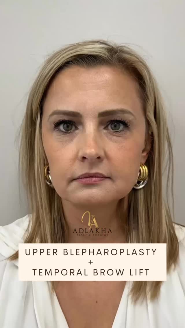 📏 Surgery of the upper face is measured in millimeters, and even millimeters of skin can globally optimize the face, giving it a more lifted, refreshed, and youthful appearance.
🔎 Procedures such as a temporal brow lift and upper blepharoplasty (eyelid lift) focus on subtle repositioning rather than large changes, with the goal of restoring natural contour and expression.
⏳ Most patients experience mild to moderate swelling and bruising in the first 7–10 days, with a return to light activities within about a week.
🪡 Incisions are designed to heal discreetly, and results continue to refine over several weeks as swelling resolves.
To book your consultation you can:
📞Call 234 458 2010
📲DM @dr.vidhiadlakha
📧Email us info@adlakhaplasticsurgery.com
💻Visit the website in bio
This is an actual patient of Dr. Vidhi Adlakha. All photos are released with consent. Please do not use or distribute without permission.
#blepharoplasty #browlift #eyelidlift #hoodedeyes #antiaging