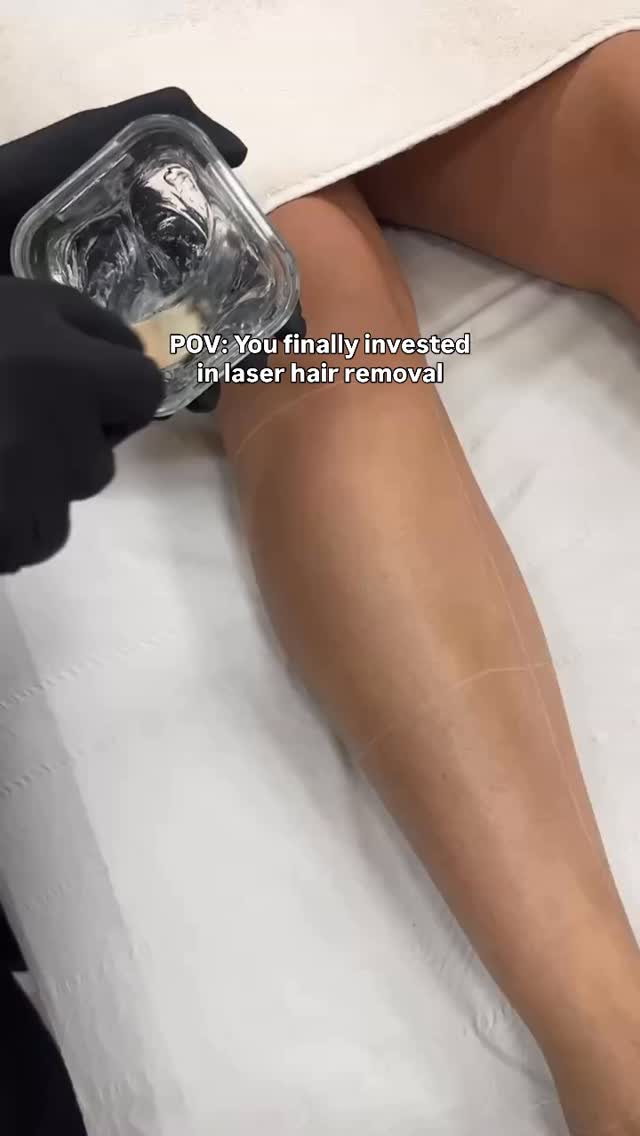 Hair removal shouldn’t be something you’re constantly thinking about.
For so many people, it becomes a routine that quietly takes up time, money, and mental space. Shaving every few days, booking waxing appointments, dealing with irritation or ingrown hairs, only for it all to start again the following week.
Laser hair removal changes that cycle.
Instead of constantly managing regrowth, treatments work progressively to reduce the hair over time. Each session weakens the follicle, meaning the hair grows back finer, softer and slower. With the right technology and the correct treatment spacing, skin becomes smoother and maintenance becomes minimal.
It’s not an overnight fix, and we’re always honest about that. Laser hair removal is a process. But it’s a process that delivers long-term freedom from the constant upkeep.
If you’re tired of shaving, waxing, or dealing with irritation, it might be time to start your laser journey. Ready to start your journey? Tap the link in our bio to book a consulation or DM the word “LASER” to learn more 💌