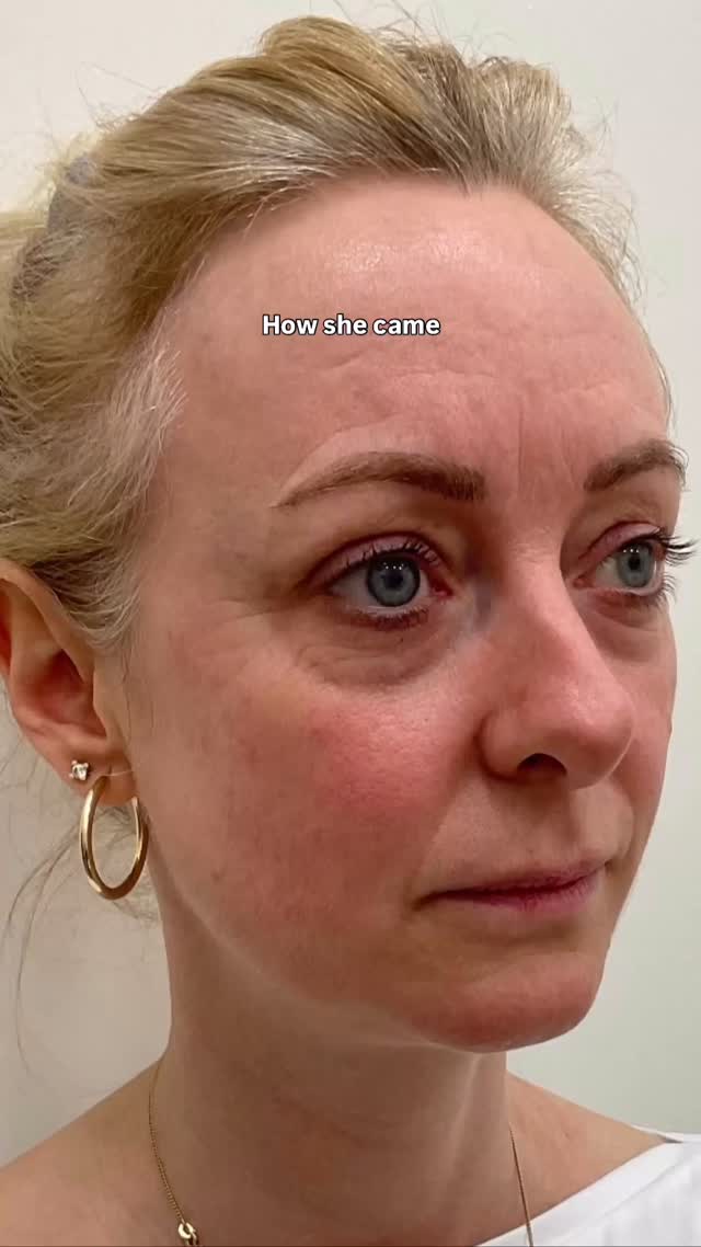 ‘s not about changing how you look, it’s about helping you look more like yourself again.
Our beautiful patient wanted to feel fresher and less tired without losing her natural features or expression. Through a carefully planned full face rejuvenation, we focused on restoring balance, structure and volume in key areas, supporting the jawline and mid-face and softening the under-eye region.
We also carried out a course of morpheus 8 to help improve skin quality alongside injectable treatments
The result is subtle yet transformative - she still looks completely like herself, just well-rested, lifted and full of life again.
When treatments are done thoughtfully, they’re not obvious. They simply bring harmony back to the face, helping light reflect in all the right places and revealing a softer, more radiant version of you.
If you’ve been feeling that your reflection doesn’t quite match how vibrant you feel inside, a full face rejuvenation might be the reset you’re looking for.
Tap the link in bio to book a consultation, and let’s design a treatment plan that feels completely you ✨
📍 Marylebone, London
📞 0203 633 4328
💌 hello@takroniclinic.com