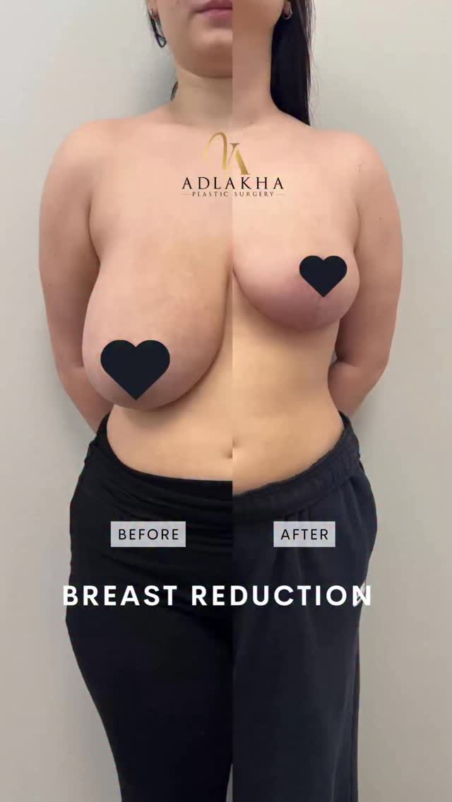 💝 Breast Reduction Surgery
✂️ Breast reduction surgery removes excess breast tissue, fat, and skin while lifting and reshaping the breasts into a more balanced, youthful position. Enlarged areolas can also be reduced when appropriate.
📏 Benefits include:
• Smaller, lighter breasts
• Improved breast shape and position
• Better body proportions
• Reduced areolar size
🩺 Patients experience relief from symptoms such as:
• Neck, shoulder, and back pain
• Bra strap grooving
• Exercise discomfort
• Moisture-related rashes beneath the breasts
⏳ Recovery is typically straightforward. Most patients return to desk work within 1–2 weeks, resume light exercise around 4 weeks, and return to full activity by 6 weeks.
✨ This patient achieved a smaller breast size, improved breast position, and a more proportional contour while reducing the physical discomfort associated with heavy breasts.
To schedule your consultation you can:
📞Call 234 458 2010
📲DM @dr.vidhiadlakha
📧Email us info@adlakhaplasticsurgery.com
💻Visit the website in my bio
This is an actual patient of Dr. Vidhi Adlakha. All photos are released with consent. Please do not use or distribute without permission.
#plasticsurgery #beforeandafter #bodytransformation #breastreduction #adlakhaaesthetics