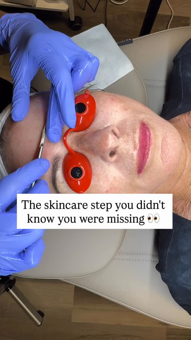 ✨$75 and can be repeated every 4-6 weeks!
(And no tipping allowed - it's medical 😉)
.
Why my patients love dermaplaning:
•smooths texture
•removes dead skin and peach fuzz
•brighter, more radiant complexion
•better skincare product absorption
•flawless makeup application
•gentle exfoliation with no downtime
.
Book yours today!
.
•BOOK WITH ME •
💻www.allureaw.com
📞 563-258-4698
📧 info@allure-dbq.com
.
•FOLLOW ME •
Nicole Powers, ARNP, AGNP-BC
Allure Aesthetics + Wellness
@allure_iowa
#maquoketa #dermplaning #nursepractitioner #nurseinjector #easterniowa