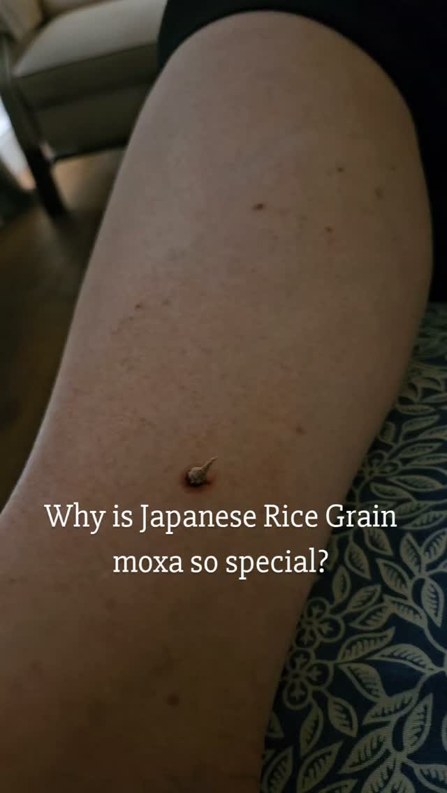 Most people have heard of acupuncture.
Far fewer have ever seen Japanese rice grain moxibustion.
This is one of the most refined and technically demanding, precise forms of moxa therapy, requiring extensive training, patience, and exceptional control.
Tiny grains of ultra-fine moxa, each no larger than a grain of rice (and often much smaller), are carefully shaped by hand and placed on specific acupuncture points. A special protective medium called Shiunko (Shuinku) paste is applied to the skin first to protect it. This too is handmade.
Unlike larger moxa techniques that create broad warmth, Japanese rice grain moxa delivers an incredibly focused stimulus. The practitioner carefully controls every grain, every burn, and every sensation. Precision is everything.
This isn't simply about applying heat. It is a highly sophisticated branch of Japanese acupuncture, used to influence the body's Qi with remarkable accuracy. The technique can gently strengthen deficiency, support immunity, encourage circulation, relieve pain, and regulate the body's natural healing processes, all while using only tiny amounts of moxa.
Learning this method takes dedicated postgraduate training and many hours of practice. Every grain is hand-made during treatment, and every application is intentional.
It's one of the reasons I continue to study traditional Japanese acupuncture techniques. They allow me to offer treatments that are both deeply rooted in tradition and beautifully refined in their application.
Sometimes, the smallest therapies create the most profound effects. #Moxa
#acupuncturistsofinstagram
#takecontrolofyourwellbeing #wellnessthatworks #acupuncture