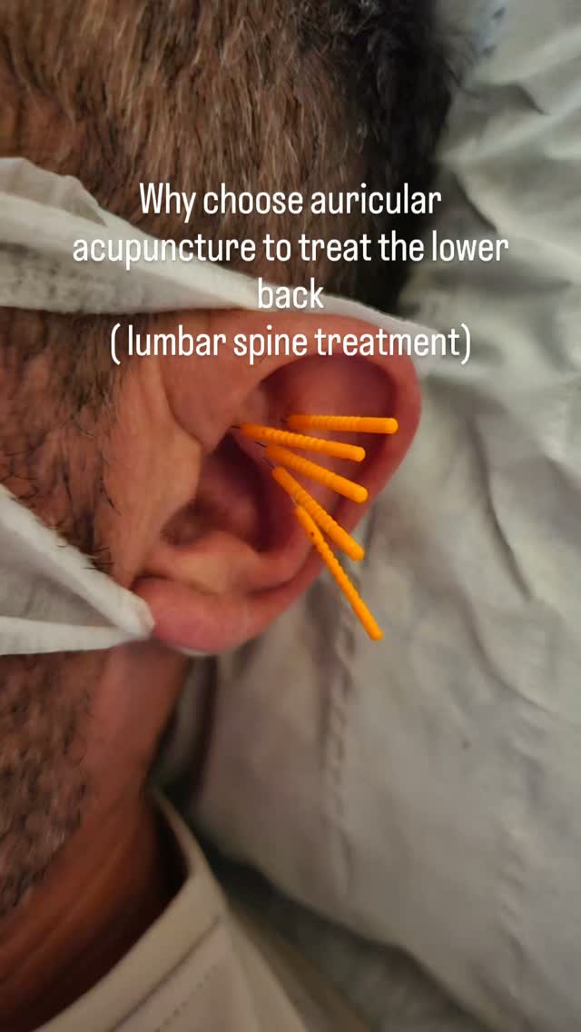 Why choose auricular acupuncture for lower back pain?
When people think of acupuncture for back pain, they naturally expect needles to be placed in the lower back. While that is often appropriate, there are many situations where treating the ear can be an excellent alternative.
Auricular acupuncture works by stimulating specific points on the ear that correspond to the lumbar spine and nervous system. The ear acts as a microsystem, allowing us to influence other parts of the body without needling the painful area itself.
This approach can be particularly beneficial if:
• Your lower back is too painful or sensitive to touch.
• You have inflammation, bruising, or skin conditions over the painful area.
• You struggle to lie comfortably on your front.
• You have acute muscle spasm, where direct needling may be uncomfortable.
• You prefer a more gentle approach to treatment.
• You need ongoing pain relief, as ear needles can often be retained safely for longer than body needles.
Auricular acupuncture also has a calming effect on the nervous system. Chronic back pain isn't just about muscles and joints, it can also involve the way the brain and nervous system process pain. By helping to regulate this response, ear acupuncture can reduce pain sensitivity and encourage the body to move more comfortably.
Sometimes, the most effective way to help a painful back isn't to treat the back directly.
#AuricularAcupuncture #takecontrolofyourwellbeing #wellnessthatworks #relaxattheretreat #wellbeingworkshops