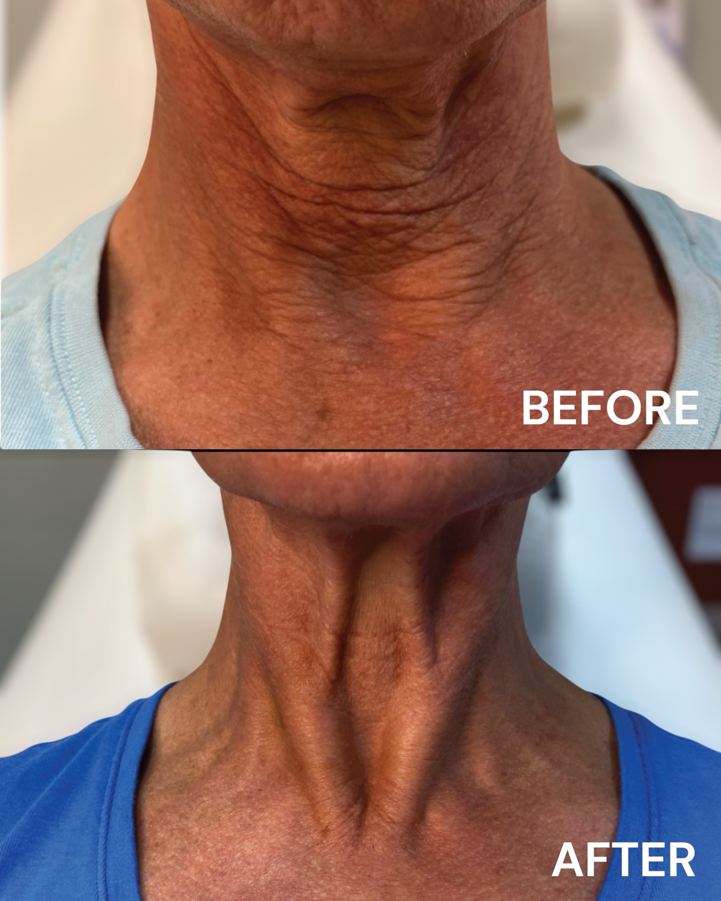 ✨ Check out these amazing before and after photos of a neck transformation using our Belotero + Radiesse blend! ✨
This powerful treatment not only lifts and smooths — it stimulates collagen growth for up to 10 months and results can last 2–3 years.
💉 Neck treatment: $975
📞 Call Dr. Dupon today to schedule your appointment and restore your youthful glow!