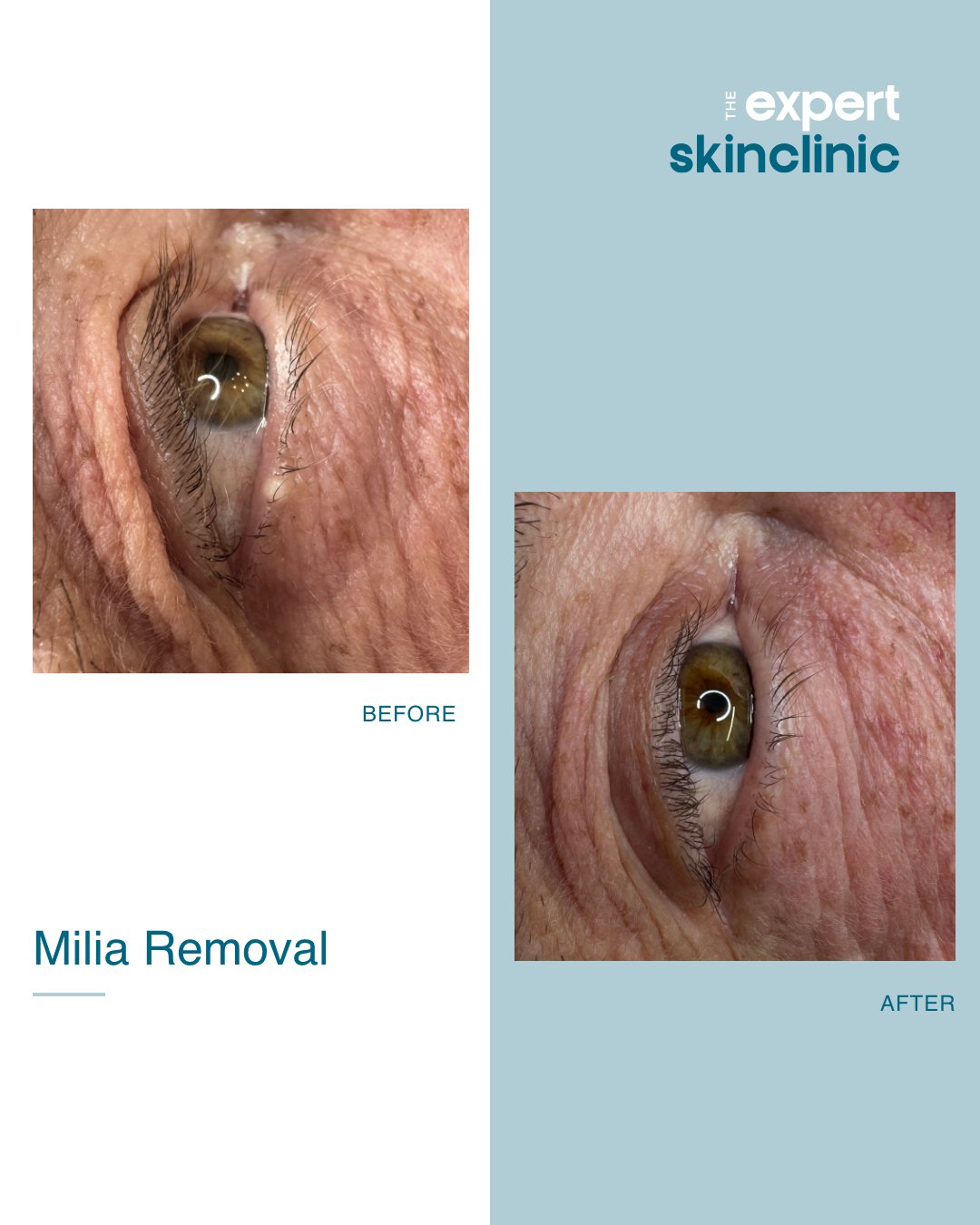 Tired of those small, white bumps around your eyes? This is called milia, which forms when keratin becomes trapped under the skin's surface, causing small white or yellow cysts.
They're harmless and will sometimes go away on their own, but can also be removed - even if in sensitive areas like this one right in the water line of the eye!
This fantastic result was achieved in just one sitting, using our specialist thermolysis pinpoint precision technique. This allowed us to safely work close to the eye for effective milia removal. After just 6 weeks, you can't even see where the milia once was and the client is very happy!
Visit our website to book a skin blemish consultation where we'll come up with a treatment planš
#milia #miliaremoval #thermolysis #skinhealth #precisionskincare