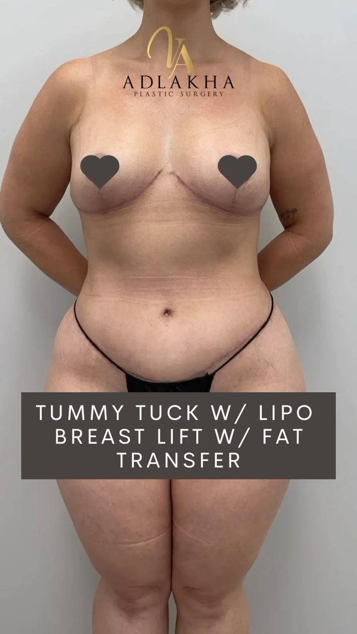 🤱A Mommy Makeover is a comprehensive body contouring surgery that includes personalized combination of procedures designed to address the physical changes that occur during and after pregnancy and breastfeeding.
🧚🏼♀️It most commonly includes a tummy tuck, breast lift and/or augmentation, and liposuction - but the approach is tailored to each patient’s unique goals and anatomy.
👆🏼This mommy makeover = Tummy Tuck + Liposuction Flanks & Lower Back + Breast Lift with Autologous fat transfer
✅ Abdominoplasty: Removal of excess skin and tightening of the abdominal wall musculature
✅ Liposuction: Flank and back contouring for improved waist definition
✅ Mastopexy: Lifting, tightening the skin envelope and reshaping of the breasts without implants
✅ Small volume fat transfer to breasts to enhance shape and volume without use of breast implants
🎯 Customized plan
🛡️ Safety first
📍 Board-certified results
🔎Results shown in early healing phase. Scars will continue to fade over time with proper aftercare and scar management protocol.
🪡Individualized surgical planning for optimal symmetry and proportion.
To book your consultation you can:
📞Call 234 458 2010
📲DM @dr.vidhiadlakha
📧Email us info@adlakhaplasticsurgery.com
💻Visit the website in my bio
.
.
.
This is an actual patient of Dr. Vidhi Adlakha. All photos are released with consent. Please do not use or distribute without permission.
#Abdominoplasty #BreastLift #Liposuction #BodyContour #TummyTuckResults #Mastopexy #PlasticSurgeon #BeforeAndAfter
#Adlakhaaesthetics #fattransfer #adlakhaplasticsurgery #reels #transformationtuesday #weightloss #bodycontouring #mommymakeover
