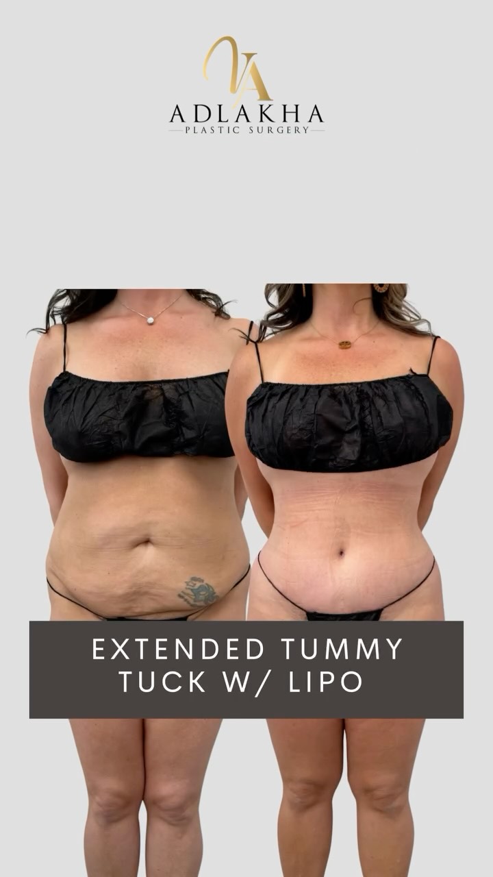 Extended Tummy Tuck with Flank Liposuction
✨Abdominoplasty:
Focuses on the front of the abdomen- tightening muscles and removing excess skin for a flatter stomach.
✨Extended Abdominoplasty:
Goes beyond the front to address the sides/flanks, improving waist definition and smoothing contours toward the hips. Longer scar extending to the lower back.
⏳An extended tummy tuck combined with liposuction of the flanks is designed for patients who need more comprehensive contouring of the abdomen and waist.
📝This approach addresses:
• Excess skin of the abdomen
• Muscle separation (diastasis recti)
• Stubborn fat and skin extending toward the hips and lower back
📝The tummy tuck tightens the abdominal muscles and removes excess skin, while flank liposuction sculpts the waist, creating smoother side contours and improved definition.
👩🏻⚕️ Ideal patients:
This procedure is appropriate for patients after pregnancy or significant weight loss who need more comprehensive contouring.
🪡Individualized surgical planning for best results.
To book your consultation you can:
📞Call 234 458 2010
📲DM @dr.vidhiadlakha
📧Email us info@adlakhaplasticsurgery.com
💻Visit the website in my bio
.
.
.
This is an actual patient of Dr. Vidhi Adlakha. All photos are released with consent. Please do not use or distribute without permission.
#Abdominoplasty #BreastLift #Liposuction #mommymakeover #TummyTuckResults