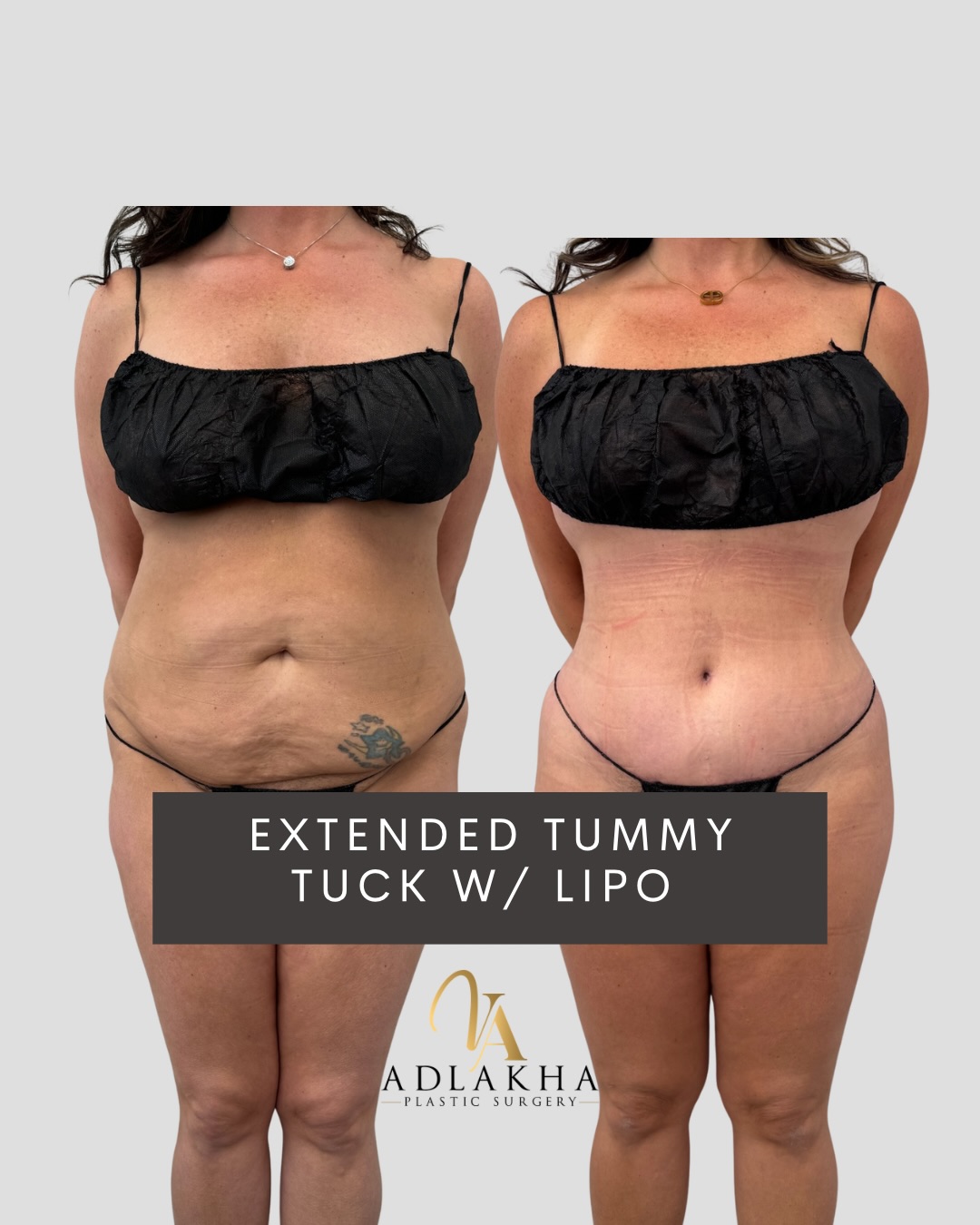 Extended Tummy Tuck with Flank Liposuction
✨Abdominoplasty:
Focuses on the front of the abdomen- tightening muscles and removing excess skin for a flatter stomach.
✨Extended Abdominoplasty:
Goes beyond the front to address the sides/flanks, improving waist definition and smoothing contours toward the hips. Longer scar extending to the lower back.
⏳An extended tummy tuck combined with liposuction of the flanks is designed for patients who need more comprehensive contouring of the abdomen and waist.
📝This approach addresses:
• Excess skin of the abdomen
• Muscle separation (diastasis recti)
• Stubborn fat and skin extending toward the hips and lower back
📝The tummy tuck tightens the abdominal muscles and removes excess skin, while flank liposuction sculpts the waist, creating smoother side contours and improved definition.
👩🏻⚕️ Ideal patients:
This procedure is appropriate for patients after pregnancy or significant weight loss who need more comprehensive contouring.
🪡Individualized surgical planning for best results.
To book your consultation you can:
📞Call 234 458 2010
📲DM @dr.vidhiadlakha
📧Email us info@adlakhaplasticsurgery.com
💻Visit the website in my bio
.
.
.
This is an actual patient of Dr. Vidhi Adlakha. All photos are released with consent. Please do not use or distribute without permission.
#Abdominoplasty #BreastLift #Liposuction #BodyContour #TummyTuckResults