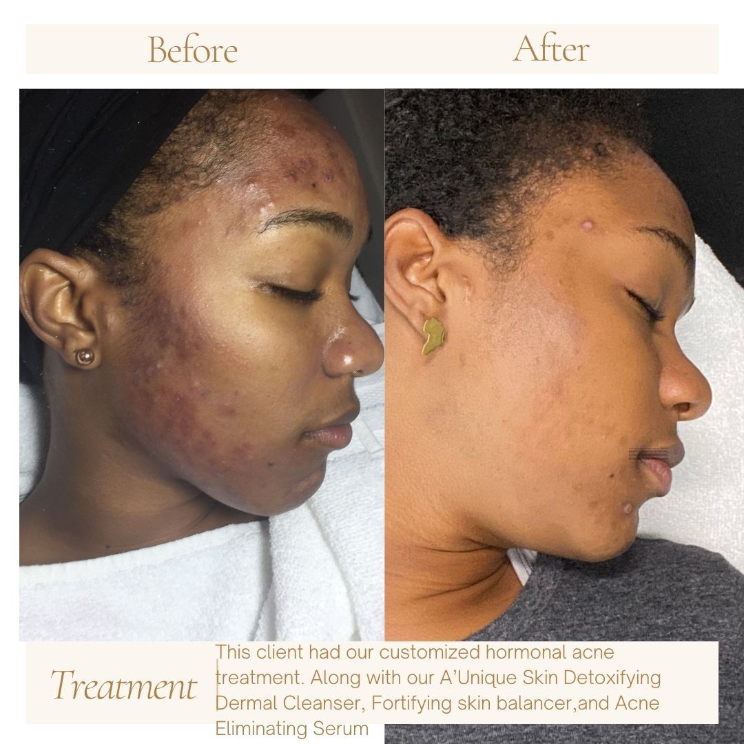 Using A’Unique Skin skincare products offers a range of impressive benefits:
1. Improved Skin Texture and Clarity- The products help refine skin texture, resulting in a smoother and more even complexion.
2. Deep Hydration- Formulated with potent hydrating ingredients, the products provide long-lasting moisture without greasiness, leaving skin plump and supple.
3. Anti-Aging Properties- Rich in antioxidants and anti-aging compounds, the skincare line reduces the appearance of fine lines and wrinkles, promoting a youthful look.
4. Natural Ingredients - A’Unique Skin prioritizes high-quality, natural ingredients that nourish and protect the skin, minimizing the risk of irritation and adverse reactions.
5. Radiant Glow- Regular use results in a healthy, radiant glow, as the products enhance skin's natural luminosity.
6. Targeted Solutions- The range addresses specific skin concerns such as dryness, acne, and hyperpigmentation with effective, targeted formulations.
7. Enhanced Resilience- Strengthens the skin barrier, making it more resilient against environmental stressors and reducing sensitivity.
8. Luxurious Experience- The thoughtfully crafted products offer a luxurious skincare experience,
combining efficacy with indulgence.
Overall, A’Unique Skin skincare products deliver visible improvements and long-term benefits, making them an excellent choice for achieving and maintaining healthy, beautiful skin.
#skincare #skincareroutine #skincareproducts #correctiveskincare #hormonalacne #glowingskin #antiaging #cosmetics #healthyskin #skincareresults #women #beauty #acne #rosacea #naturalskincare #men #ftlauderdaleesthetician #coralspringsesthetician #broward #coralsprings #ftlauderdale #tamarac #esthetician #parkland #miami #broward #northlauderdale #boca #Aunique skin
