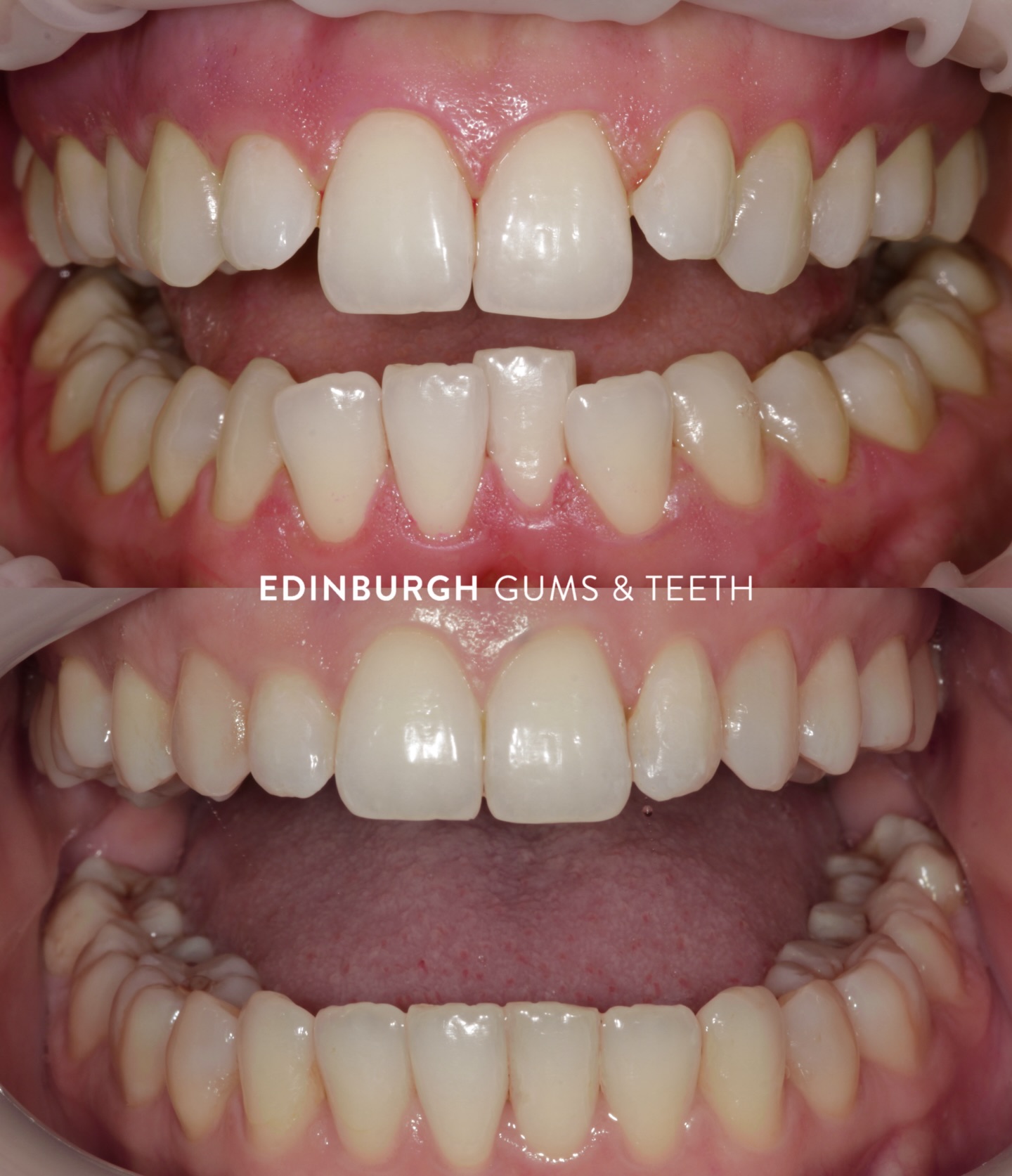 This is what Invisalign can do 👀