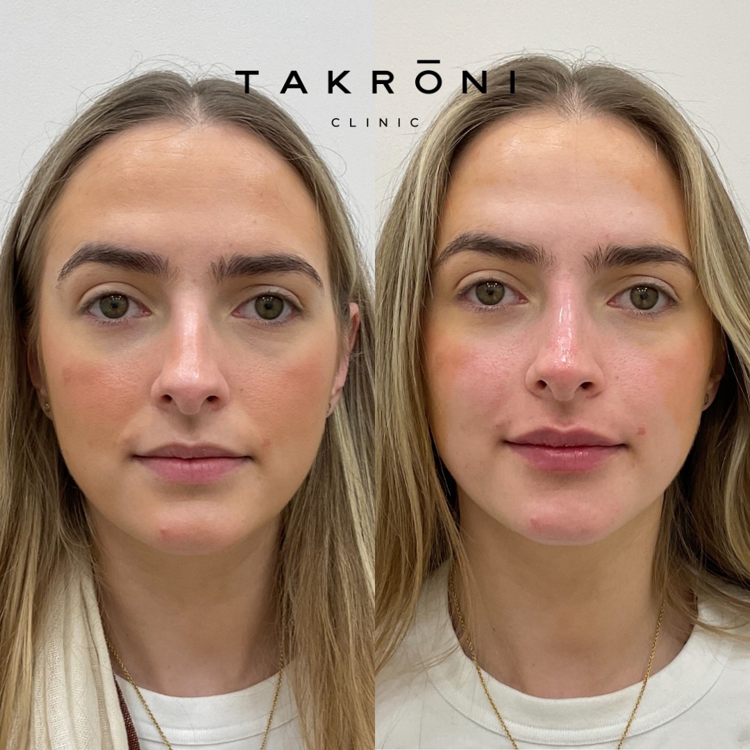 You, just fresher - that's always the goal ✨️
Early volume loss doesn’t usually show up as deep lines straight away. It’s more subtle than that. The under-eyes can start to hollow, the mid-face loses a bit of support, and everything can look slightly flatter or more tired, even when you’re not.
This is where a full-face approach matters.
Rather than treating one isolated area, strategically placed filler works by restoring support in key points across the face. By subtly lifting the mid-face and softening the transition under the eyes, we can improve how light reflects across the skin, which is what gives that fresher, more rested appearance.
It’s all about restoring what’s been lost, in a way that keeps everything balanced, natural, and proportionate.
The result should simply look healthier, brighter, and more like you on your best day.
If you’ve been feeling like you look a little more tired or less defined but you’re not sure where to start, book a consultation and we’ll map it out properly together 💌