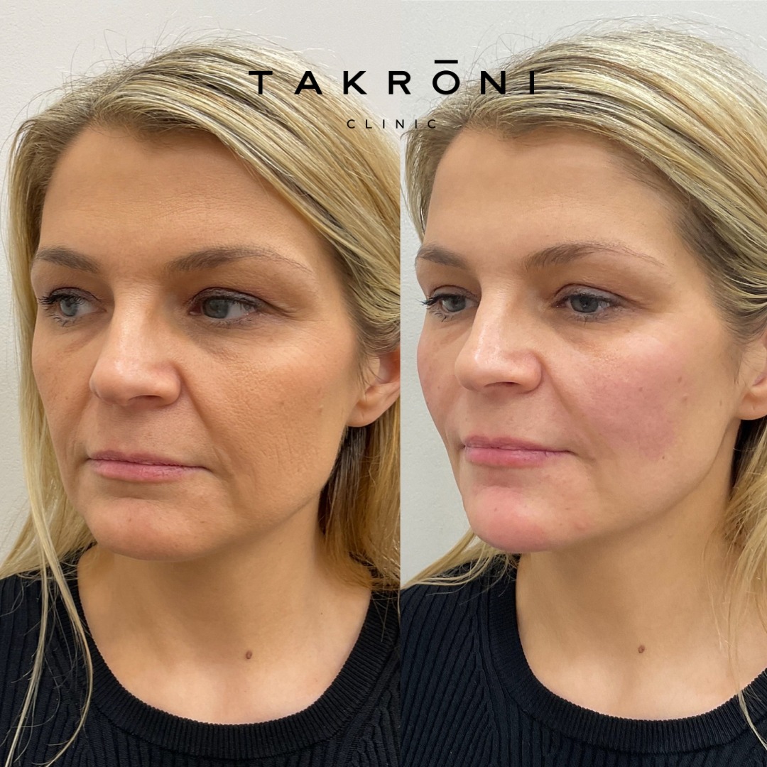 Looking tired isn’t always about your skin. It’s often about what’s happening underneath it.
As we lose support through the mid-face, everything starts to shift slightly downwards. The cheeks flatten, lines around the mouth deepen, and the lower face can begin to feel heavier or less defined. It’s subtle, but it changes how the whole face reads.
This is where full face rejuvenation comes into its own.
Rather than treating one line or one area, we restored structure where it had been lost. Carefully placed filler through the cheeks, chin and lower face to rebuild support, soften shadows and bring everything back into proportion.
What that’s done here:
• Lifted and supported the mid-face, which softens the under-eye area
• Reduced heaviness around the mouth without overfilling the lines
• Improved definition through the chin and jawline so the face sits more cleanly
The result isn’t about looking “done.” It’s about looking fresher, more rested, and more like yourself again.
Good injectable work should never be obvious. It should make the whole face make sense again.
If you’ve started to notice these kinds of changes but aren’t sure what’s driving them, that’s exactly what a consultation is for. We’ll assess properly and build a plan that’s tailored to your face, not a one-size approach.
📍 Marylebone, London
📞 0203 633 4328
💌 hello@takroniclinic.com