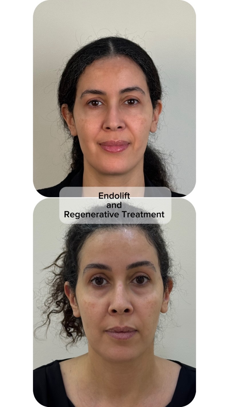 She just mentioned most important point 🤌🏼
She said after treatment , she look like few years back herself ✴️😎
This exactly what we want when we focus on regeneration rather than immediate correction ✌🏼😎
.
.
.
#endoliftdubai #endolift #regeneration #regenerativetreatment