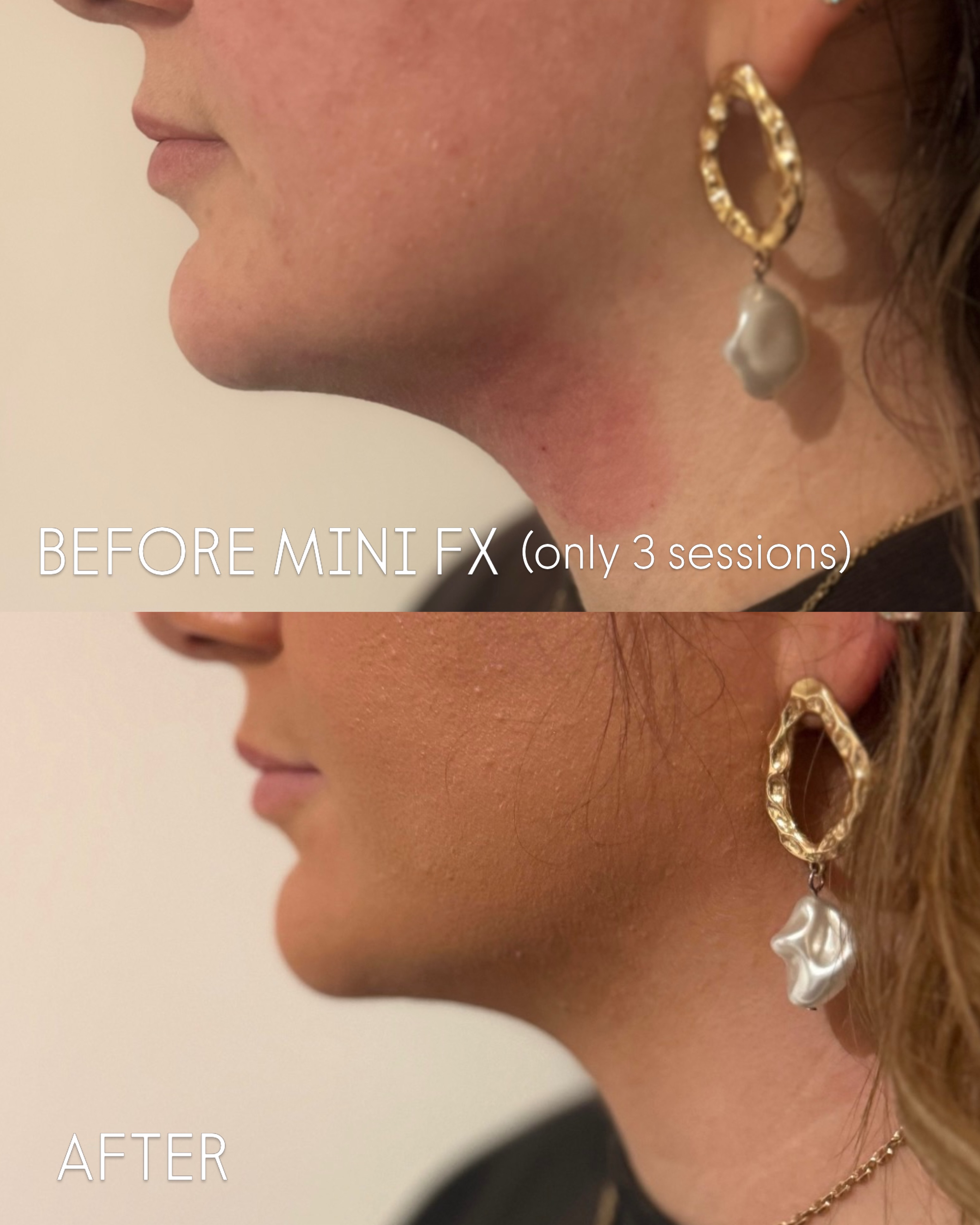 Our clients favourite treatments at the moment - the results truly speak for themselves. Free consultations - book via the link in the bio.
#vasculaze #minifx #fatreducction #lumecca #antiwrinkle