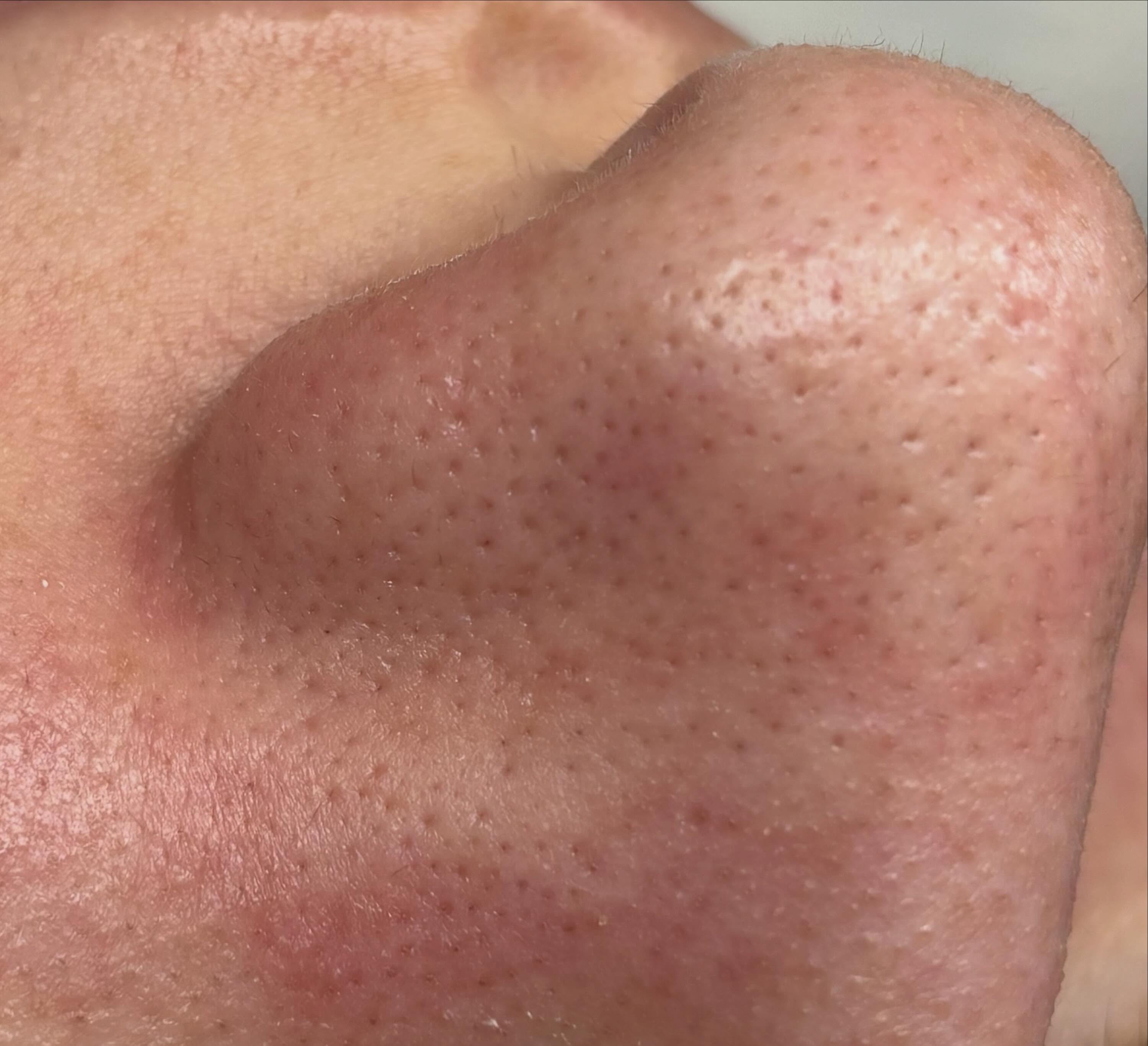 ✨ Tschüss Unreinheiten – hallo frische, reine Haut! ✨
Verstopfte Poren, Mitesser, Unterlagerungen und ein unebenes Hautbild? Unsere Deep Clean Behandlung sorgt für eine porentiefe Ausreinigung und lässt deine Haut wieder frei durchatmen.
💆🏼♀️ Die Behandlung beinhaltet:
✨ Abreinigung der Haut
✨ Enzympeeling zur sanften Lösung abgestorbener Hautschüppchen
✨ Bedampfung der Haut
✨ Gründliche manuelle Ausreinigung
✨ Zusätzliche Tiefenreinigung mit dem Skin Scrubber
✨ Beruhigende Abschlusspflege
✨ LED-Lichttherapie für ein ebenmäßiges und strahlendes Hautbild
Durch die intensive Reinigung werden Talg, Schmutz und Verhornungen entfernt, die Poren verfeinert und das Hautbild sichtbar verbessert. Die Haut wirkt frischer, klarer und kann Pflegeprodukte anschließend viel besser aufnehmen. 🌿
💛 Gut zu wissen: Die porentiefe Ausreinigung ist nicht nur als eigenständige Deep Clean Behandlung buchbar, sondern ist auch Bestandteil unserer anderen Gesichtsbehandlungen. Denn eine gründlich gereinigte Haut bildet die Basis für optimale Behandlungsergebnisse und einen gesunden Glow. ✨
📍 Perfekt bei:
• Mitessern und verstopften Poren
• Unreiner oder fettiger Haut
• Unterlagerungen
• Fahlem, unebenem Hautbild
Deine Haut verdient eine Auszeit – für einen frischen Teint, verfeinerte Poren und ein sauberes, gepflegtes Hautgefühl. 🤍
📍 Salon Juna – zeitlos schön
🌐 über www.salon-juna.com buchbar. ✨