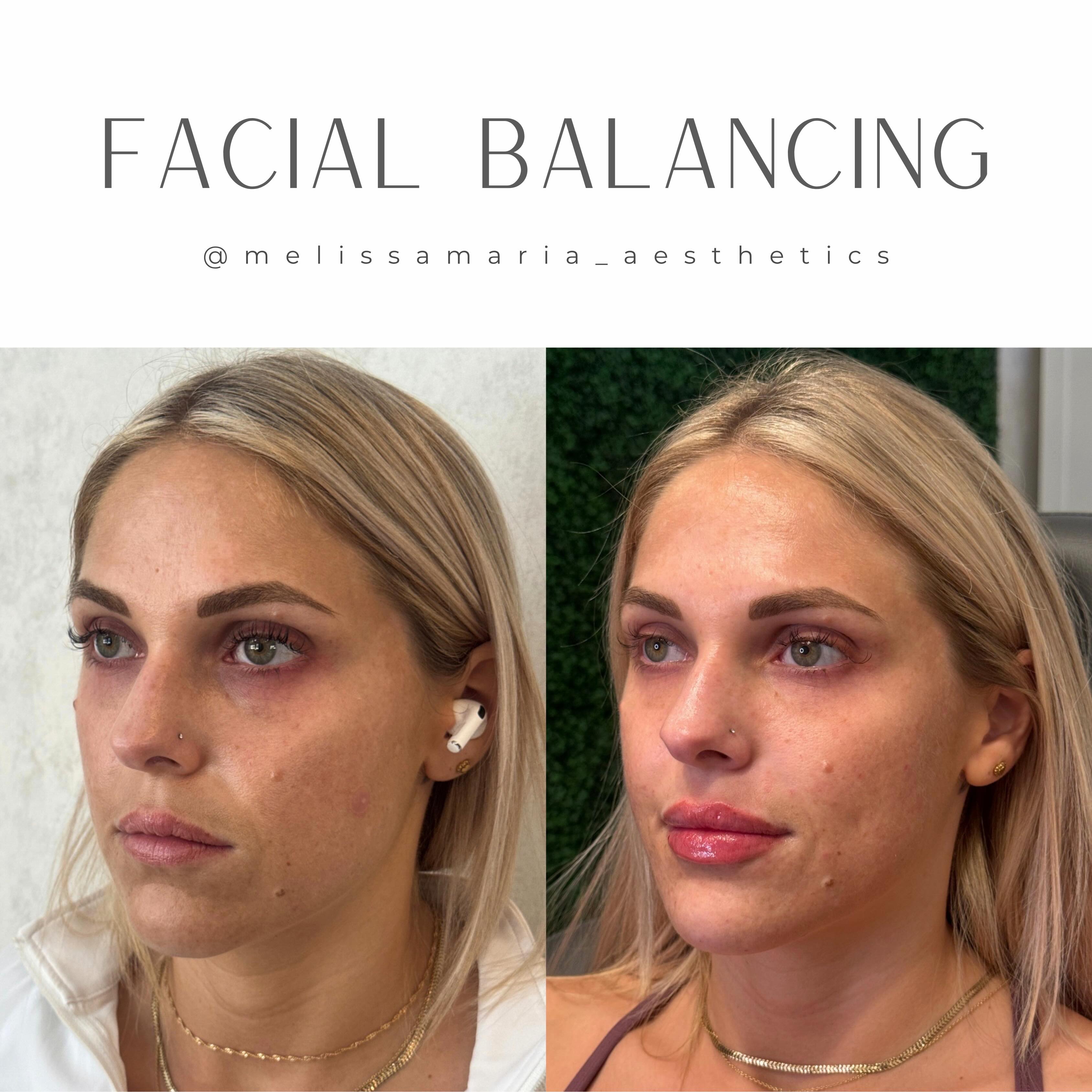 Obsessed with this transformation. Here are the areas we addressed.
Smile lines ➡️ softened
Lips ➡️ Dissolved and Refilled
Chin ➡️ Smoothed and reconnected to Jawline
Chin Shadow ➡️ Greatly Reduced
#facialbalancing #lipfierraleigh #lipsbymeli #facialbalancingraleigh