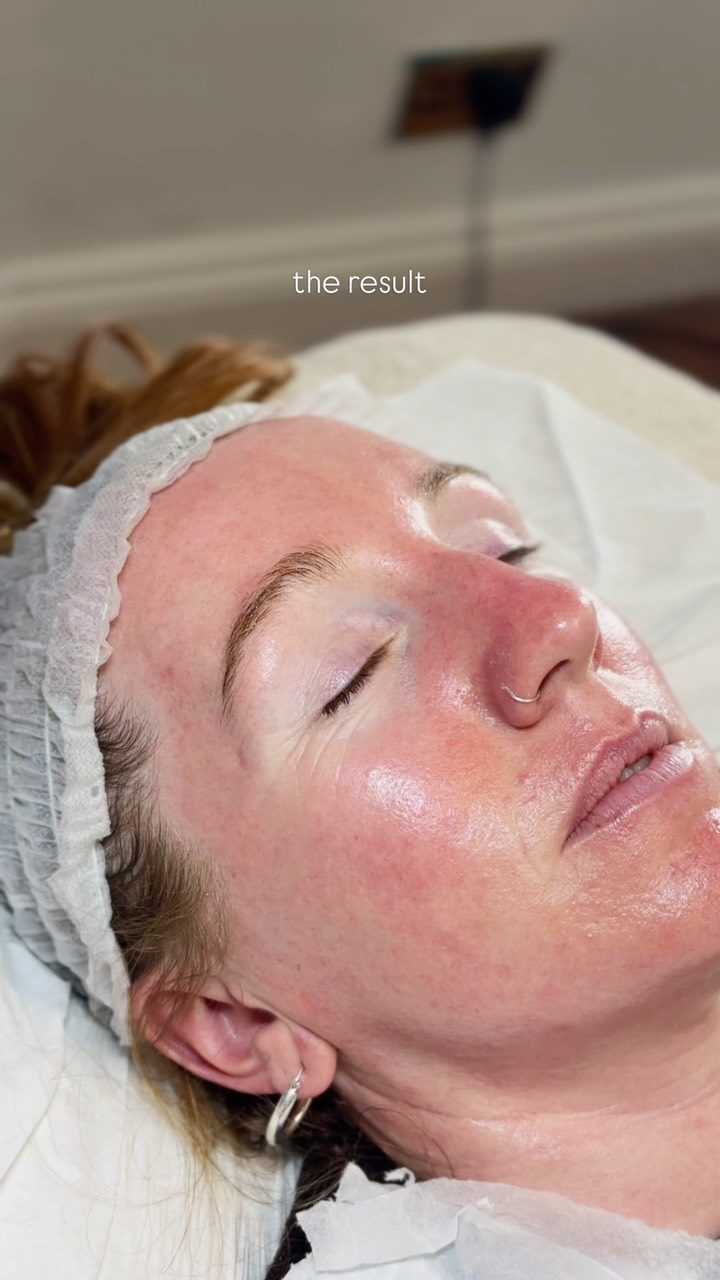 dermaplaning removes the layer of dead skin and fine facial hair sitting on the surface. what is left underneath is smoother, brighter and absorbs everything you put on it properly.
no more products sitting on top doing nothing. no more dullness that a good night’s sleep never quite fixes.
one treatment. immediate results. no downtime.
dm us to book.
#nineteenbeauty #dermaplaning #dermaplanefacial #cheltenhamaesthetics #cheltenham gloucestershire glowingskin skincareuk smoothskin resultsdrivenskincare
