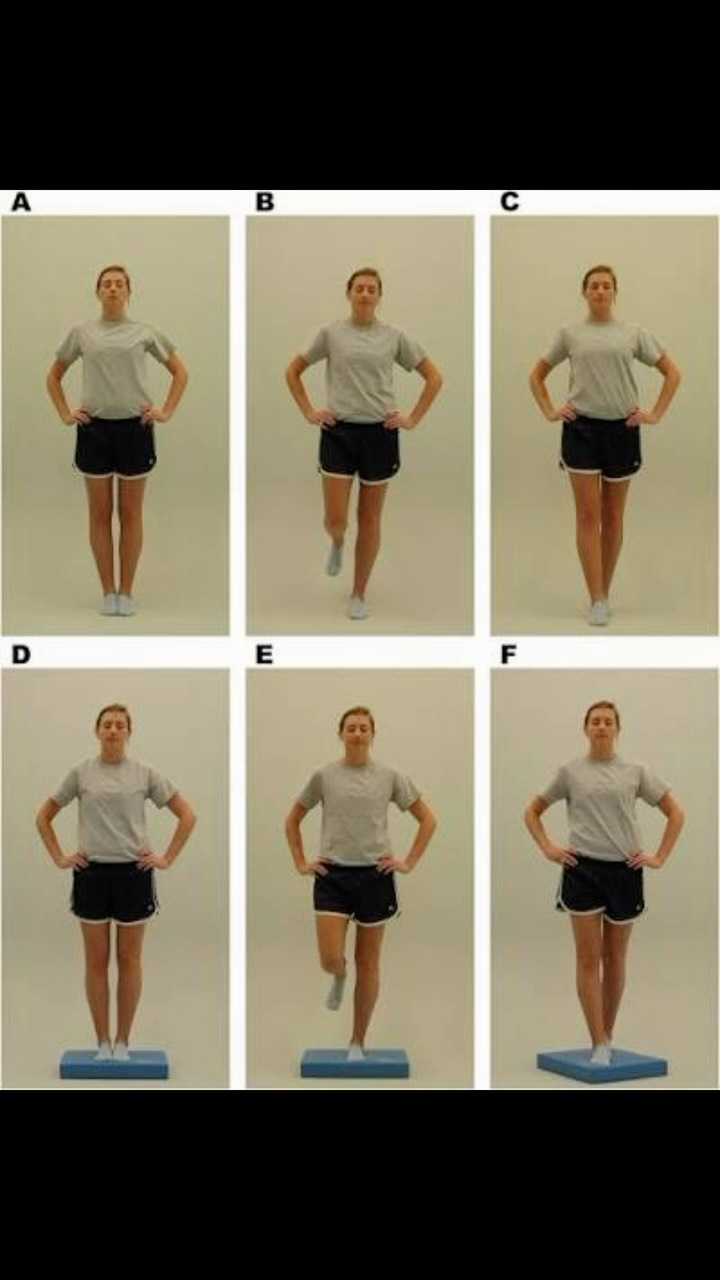 The removal of foam balance testing from the SCAT6 is often interpreted as evidence that foam conditions aren’t important.
The research says otherwise.
In fact, the SCOAT6 development papers acknowledge that foam conditions of the full BESS demonstrated better discrimination between concussed and non-concussed individuals when objective postural sway measures were used.
So why were they removed?
The answer appears to be practicality rather than performance.
The SCAT6 was designed to be used anywhere in the world—from elite sporting environments to rural clinics and sidelines. Requiring specialised equipment such as foam pads or force plates would have reduced accessibility and implementation.
This highlights an important distinction:
A test can be practical without being the most sensitive option available.
While the SCAT6 and SCOAT6 remain valuable concussion assessment tools, clinicians should recognize their limitations. Research continues to suggest that more challenging balance conditions, dual-task paradigms, and objective postural sway measurements may reveal deficits that observational testing can miss.
The question shouldn’t be whether the SCAT6 is useful.
The question should be:
Are we measuring enough to truly understand an individual’s balance dysfunction after concussion?
#Concussion #ConcussionRecovery #balancetesting #sportschiropractic #neurorehab