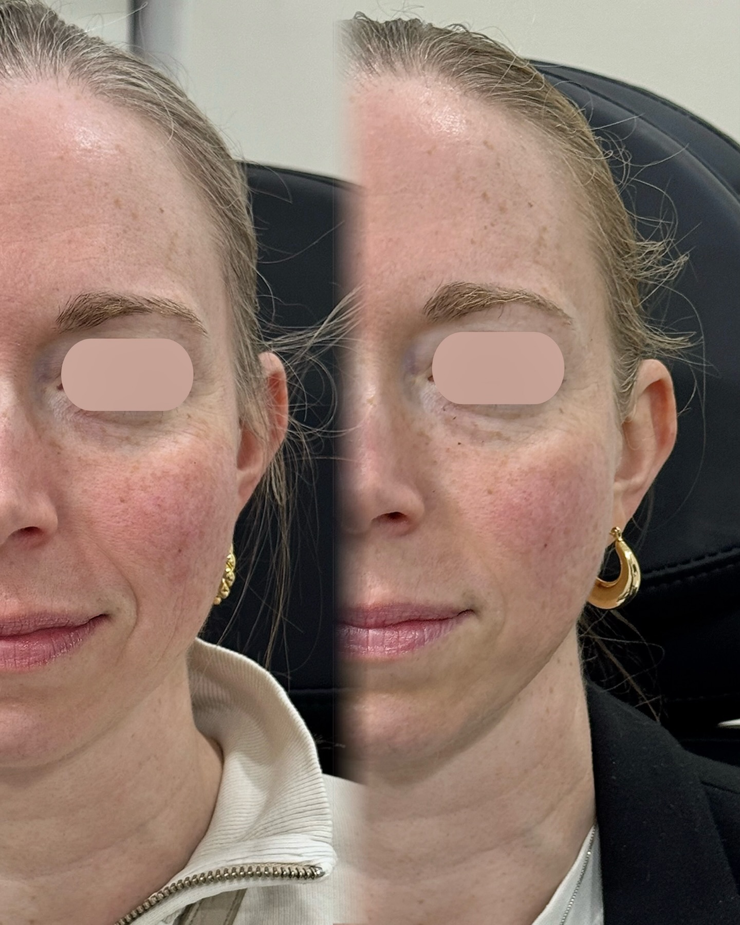 Swipe ➡️
Treatment: Collagen Stimulators
Also known as Radiesse® & Sculptra®
For more information or to book a consultation, contact us:
📱 343-451-7141
✉️ infoshaybloo@gmail.com
#filler #ottawa #nurseinjectorottawa #toronto