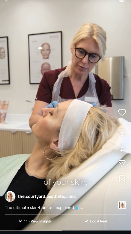 The ultimate skin-booster, explainedđ§
Unlike traditional fillers, Profhilo doesnât change your face shape, it acts like the ultimate injectable moisturiser, remodeling your skin from the inside out to boost collagen, elastin, and that healthy glow â¨
âWho is it for?
đ Anyone noticing the first signs of skin laxity
đ If your skin is feeling dull, dehydrated, or losing its bounce
đ Perfect for a natural, refreshed look (without the volume)
Have questions about Profhilo? Drop them in the comments below!
#profhilo #hydration #skininjectables #glow #skinclinic