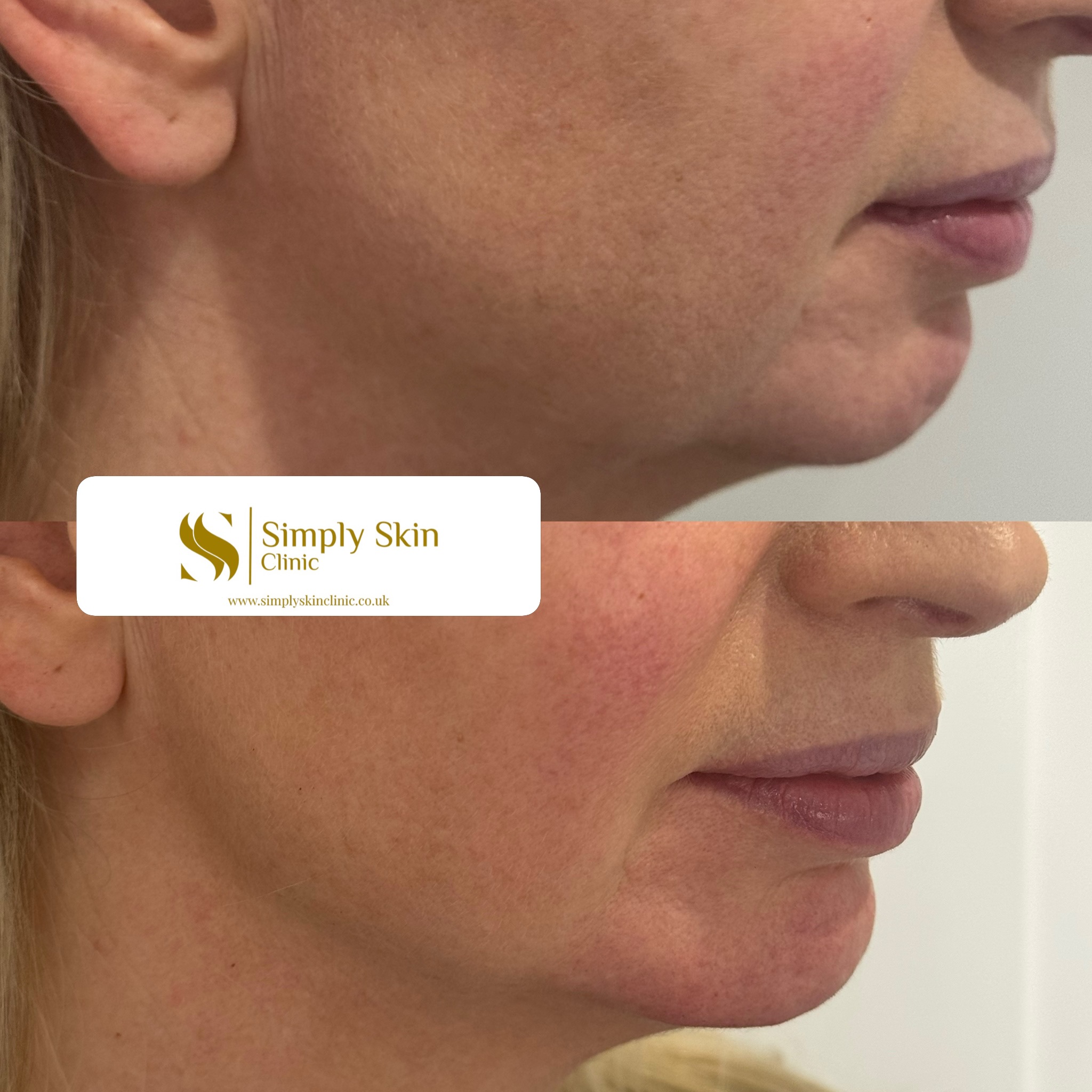 Snatched. Balanced. Effortless.
This is the power of profile correction.
Using RHA 4 Teoxane dermal filler, we’ve enhanced the chin and jawline to create a sharper, more defined side profile while keeping everything natural and in harmony with the face.
It’s not about looking “done”, it’s about structure, balance, and subtle refinement that makes a real impact.
If your profile feels soft or lacks definition, this treatment can completely elevate your look.
Appointments are limited this month. Message us to book your consultation.
#elevate #restorative #dermalfiller #winchesteraesthetics