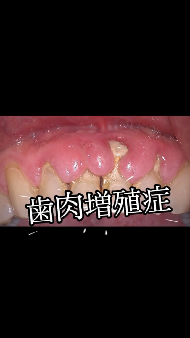 こんにちは🪥
日本顕微鏡歯科学会認定歯科衛生士の佐河です🔬
今回は歯肉増殖症の症例のご紹介です🦷
炎症により大〜きく増殖していた歯ぐきっ
⚠️1回の処置で改善したわけではありません。
患者さまのセルフケアと、マイクロスコープ下での精密な歯周病治療・継続的なメンテナンスを積み重ね、少しずつ炎症をコントロールしていきました👏🏻♩
その結果、歯肉退縮を最小限に抑えながら、本来の歯ぐきの形へ改善することができました✨
歯ぐきを「減らした」のではな
